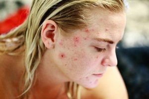 Lee más sobre el artículo La solución a las marcas de acné con Ästhetik Santander